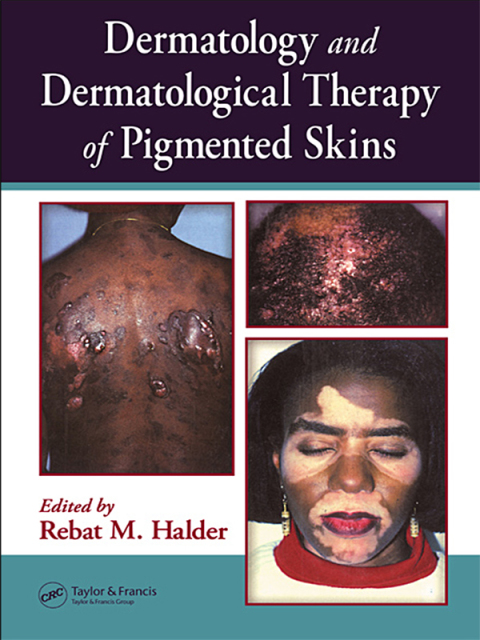Cover image for book Dermatology and Dermatological Therapy of Pigmented Skins