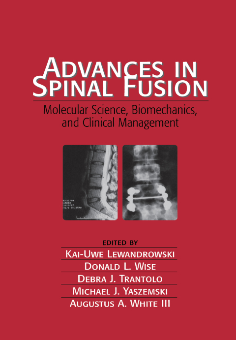 Cover image for book Advances in Spinal Fusion