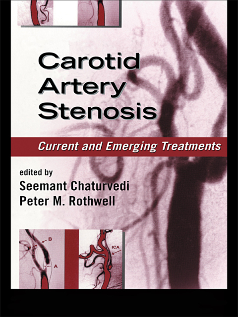 Cover image for book Carotid Artery Stenosis