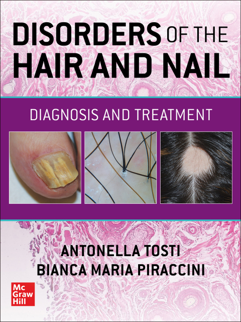 Cover image for book Disorders of the Hair and Nail: Diagnosis and Treatment