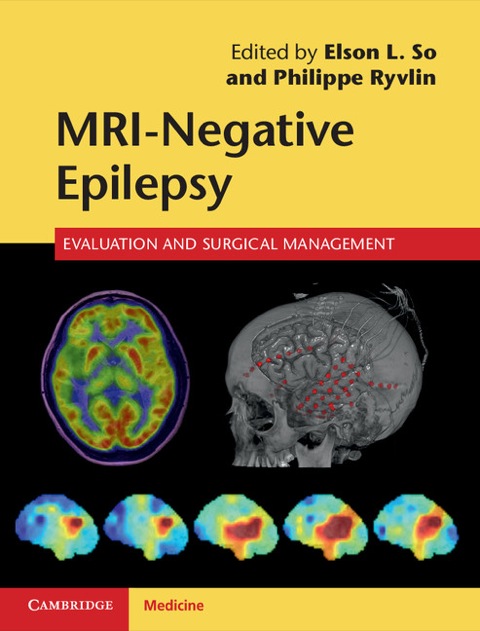 Cover image for book MRI-Negative Epilepsy