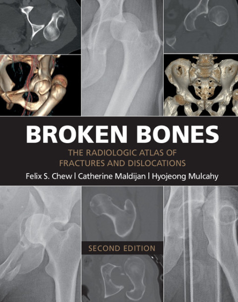 Cover image for book Broken Bones