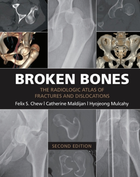 Cover image for book Broken Bones