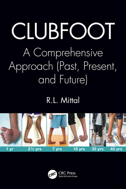 Cover image for book Clubfoot
