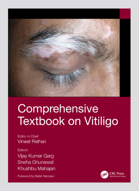 Comprehensive Textbook on Vitiligo 