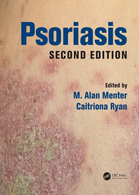 Cover image for book Psoriasis