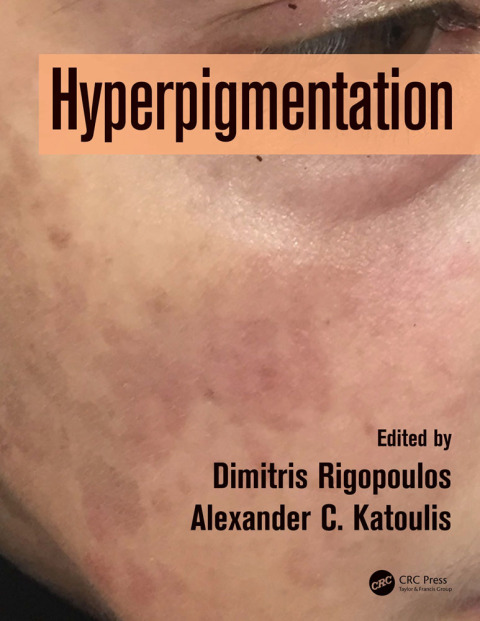 Cover image for book Hyperpigmentation