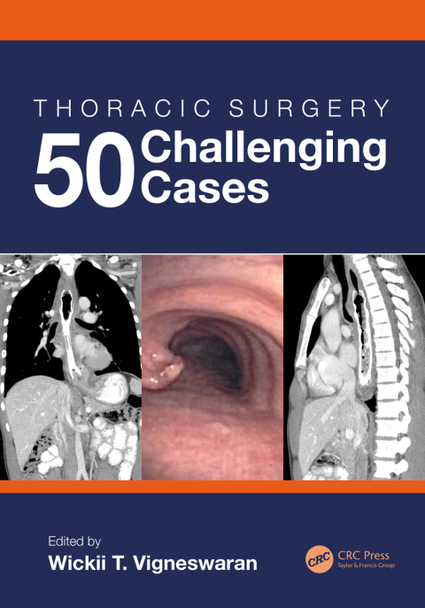 Cover image for book Thoracic Surgery: 50 Challenging cases