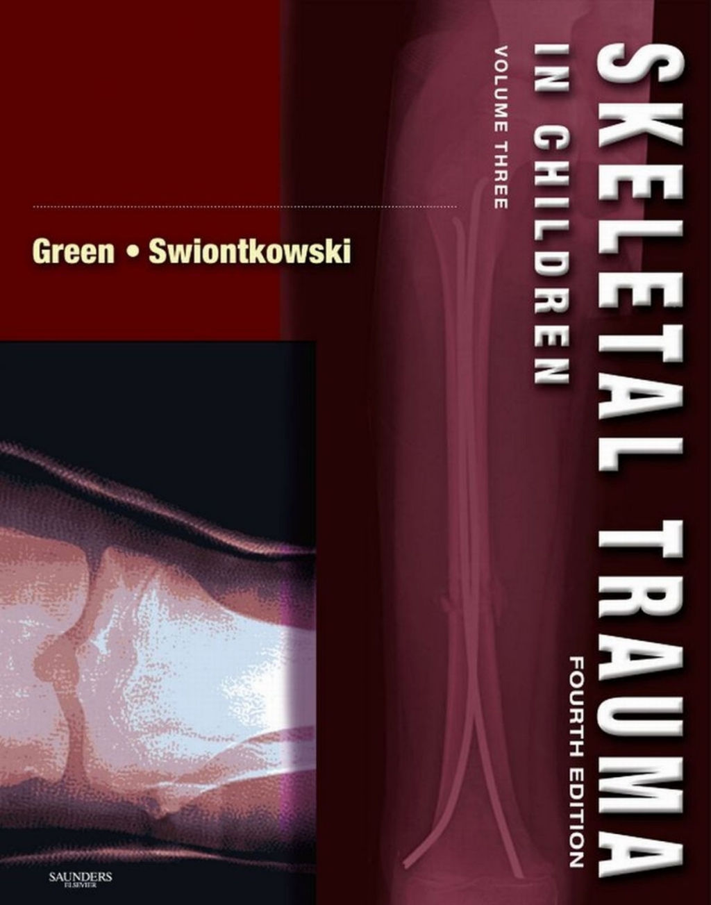 Skeletal Trauma in Children E-Book (eBook) - Neil E. Green; Marc F. Swiontkowski