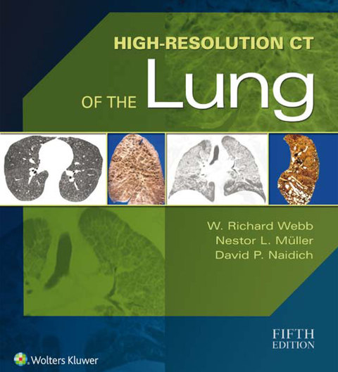 Cover image for book High-Resolution CT of the Lung