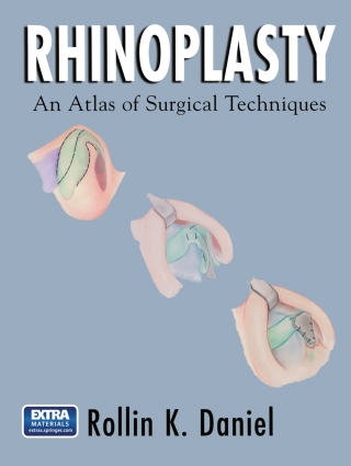 Rhinoplasty