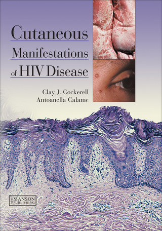 Cutaneous Manifestations of HIV Disease