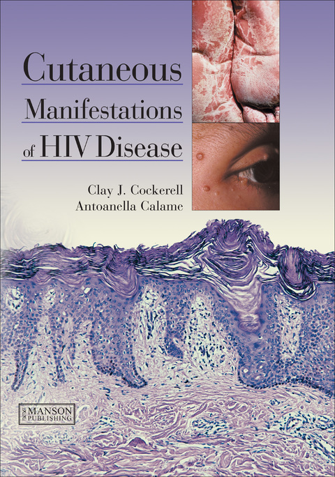 Cutaneous Manifestations of HIV Disease 