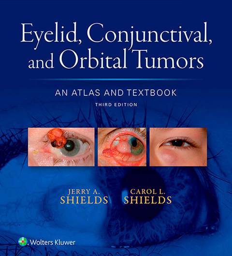 Cover image for book Eyelid, Conjunctival, and Orbital Tumors: An Atlas and Textbook