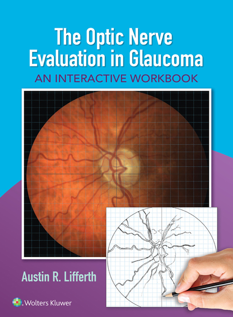Cover image for book The Optic Nerve Evaluation in Glaucoma