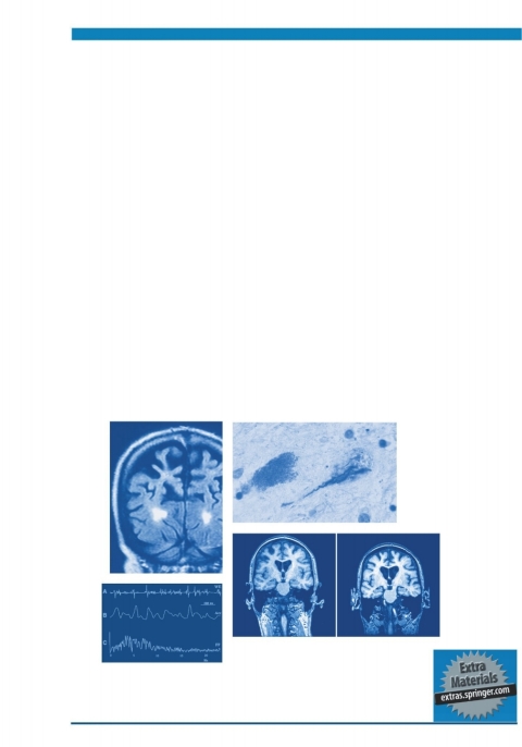 Cover image for book Atypical Parkinsonian Disorders