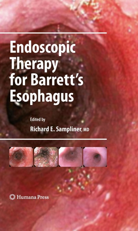 Cover image for book Endoscopic Therapy for Barrett's Esophagus