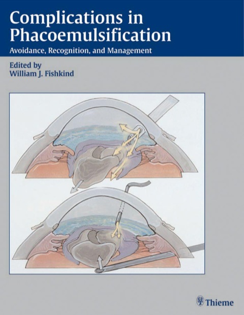 Cover image for book Complications in Phacoemulsification