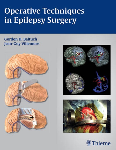 Cover image for book Operative Techniques in Epilepsy Surgery