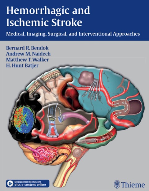 Hemorrhagic and Ischemic Stroke 