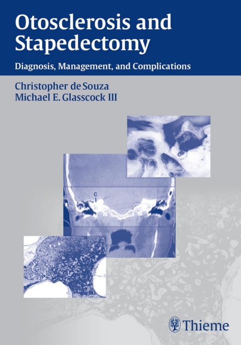 Cover image for book Otosclerosis and Stapedectomy