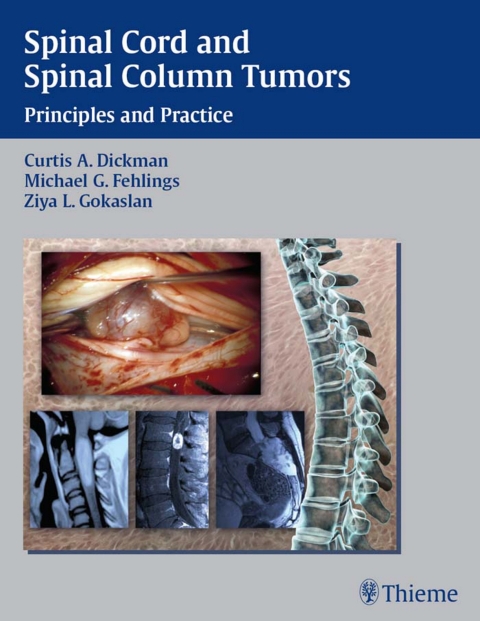 Cover image for book Spinal Cord and Spinal Column Tumors