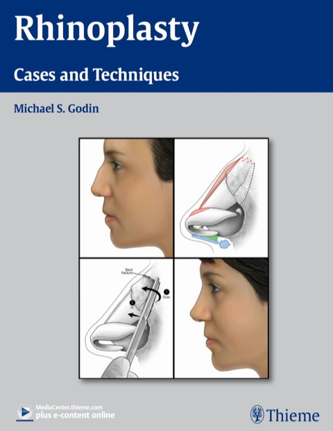 Cover image for book Rhinoplasty