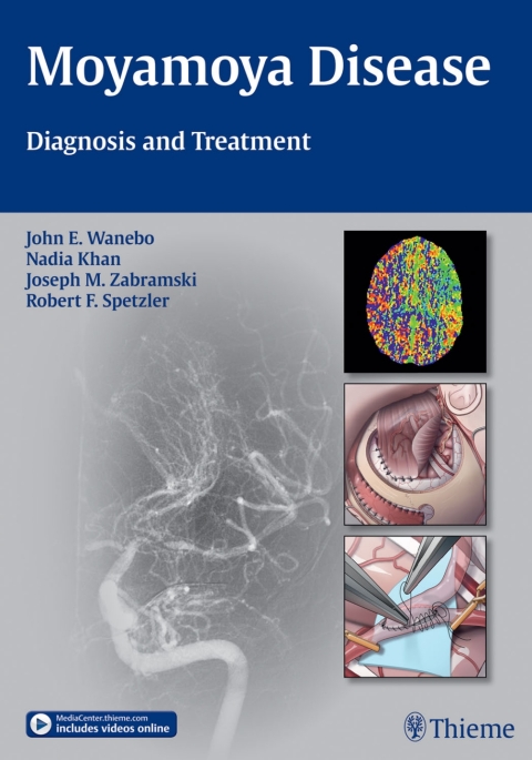 Cover image for book Moyamoya Disease