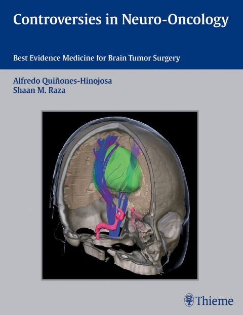 Cover image for book Controversies in Neuro-Oncology