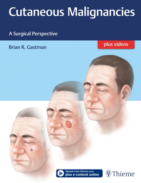 Cover image for book Cutaneous Malignancies
