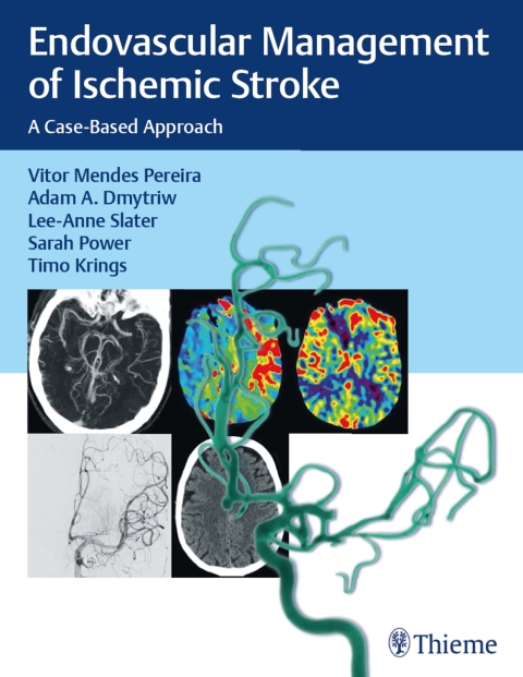 Endovascular Management of Ischemic Stroke 