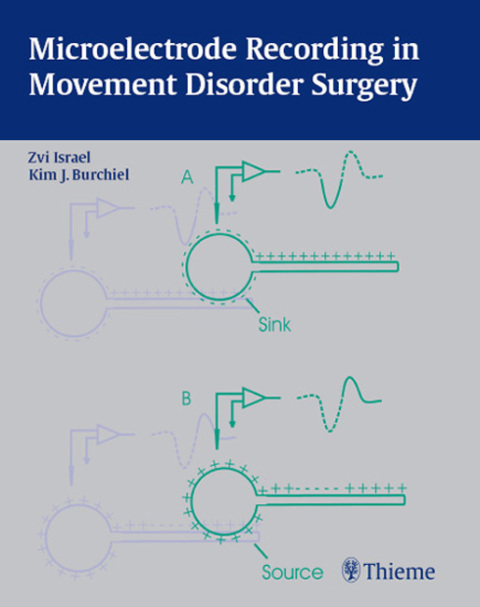 Microelectrode Recording in Movement Disorder Surgery