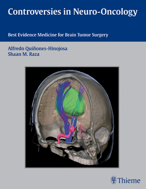 Cover image for book Controversies in Neuro-Oncology