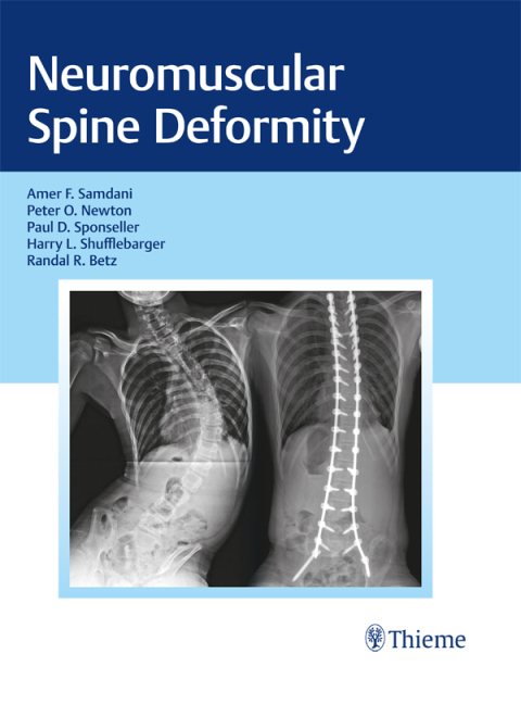 Cover image for book Neuromuscular Spine Deformity