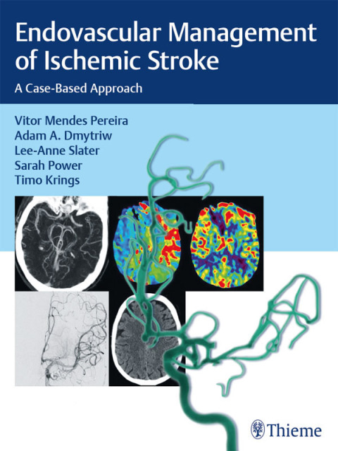 Endovascular Management of Ischemic Stroke 