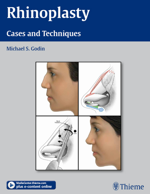 Cover image for book Rhinoplasty
