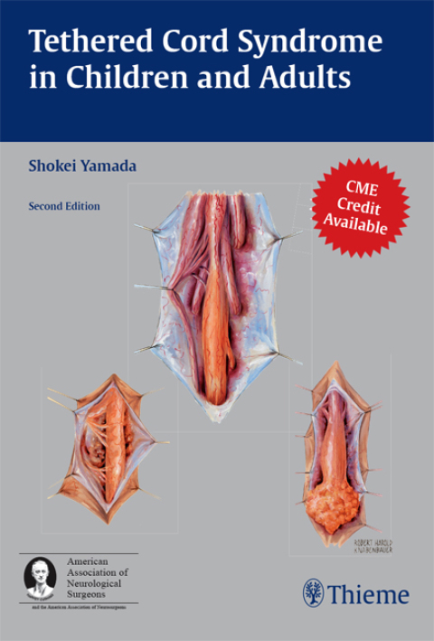 Cover image for book Tethered Cord Syndrome in Children and Adults