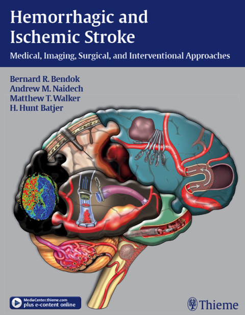 Hemorrhagic and Ischemic Stroke 