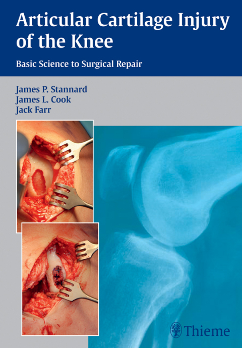 Articular Cartilage Injury of the Knee: Basic Science to Surgical Repair 