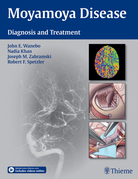Moyamoya Disease 