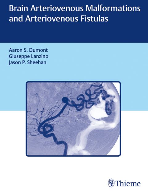 Brain Arteriovenous Malformations and Arteriovenous Fistulas 