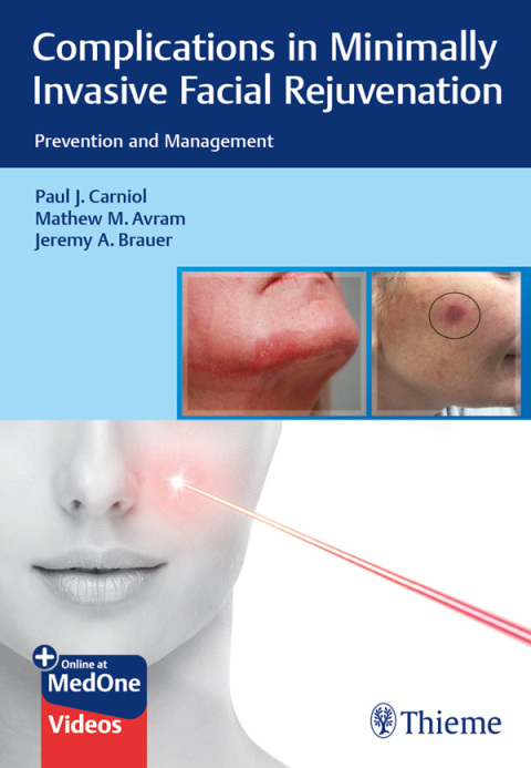 Cover image for book Complications in Minimally Invasive Facial Rejuvenation