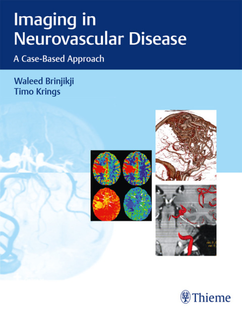 Cover image for book Imaging in Neurovascular Disease