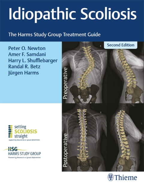 Cover image for book Idiopathic Scoliosis