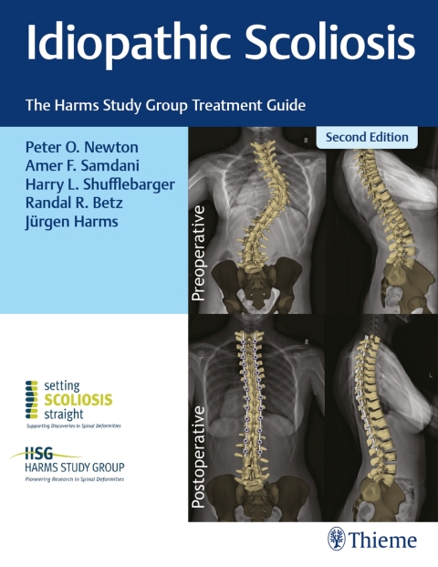 Cover image for book Idiopathic Scoliosis