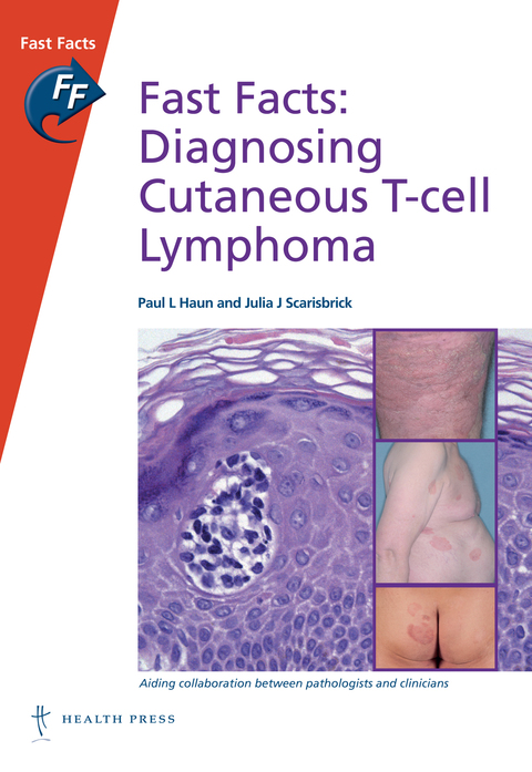 Fast Facts: Diagnosing Cutaneous T-cell Lymphoma 