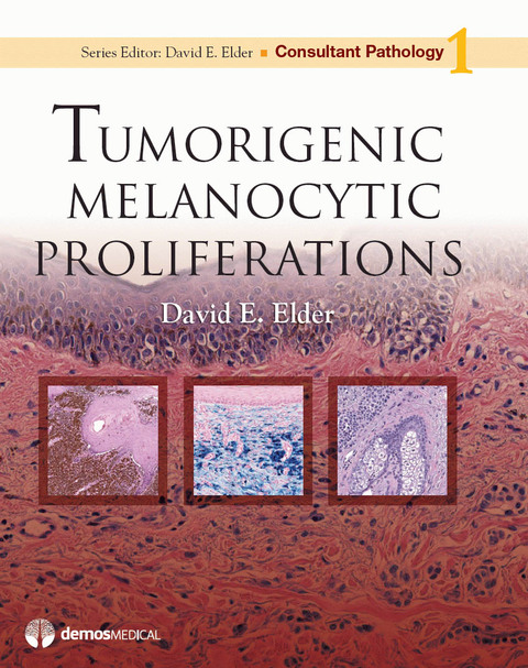 Tumorigenic Melanocytic Proliferations 
