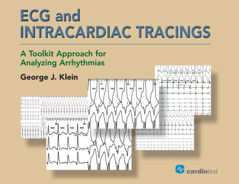 ECG and Intracardiac Tracings 