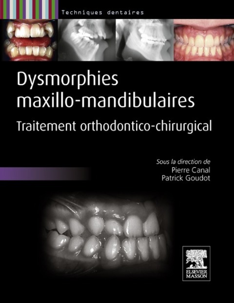 Dysmorphies maxillo-mandibulaires 