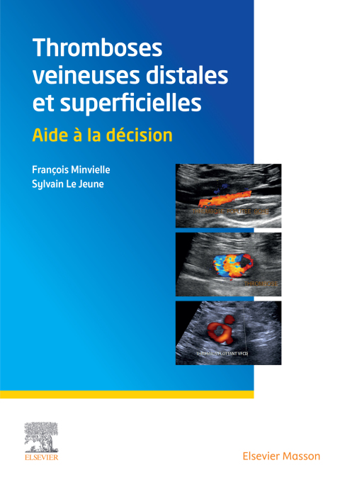 Cover image for book Thromboses veineuses distales et superficielles